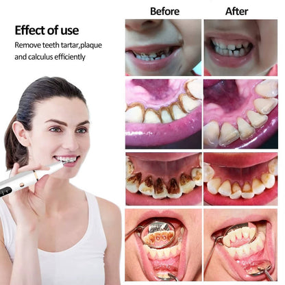 Electric Dental Calculus & Tartar Remover
